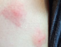 Εξανθήματα από τσιμπήματα ψύλλων