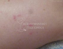 Τσιμπήματα κοριών