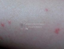 Τσιμπήματα κοριού