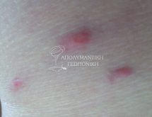 Εξανθήματα από δείγματα ψύλλων