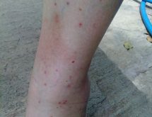 Τσιμπήματα από ψύλλους